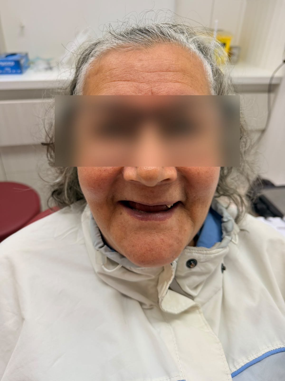 Caso real: dentadura de una paciente antes del tratamiento dental