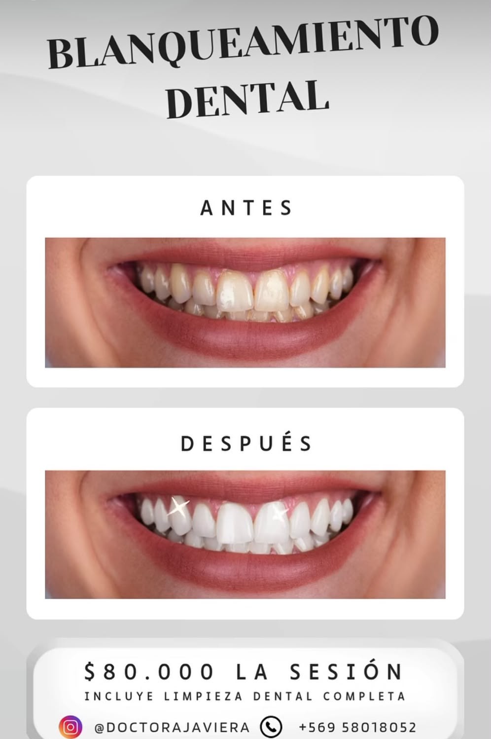 Blanqueamiento dental a $80.000 la sesión, incluye limpieza dental completa, con foto antes y después
